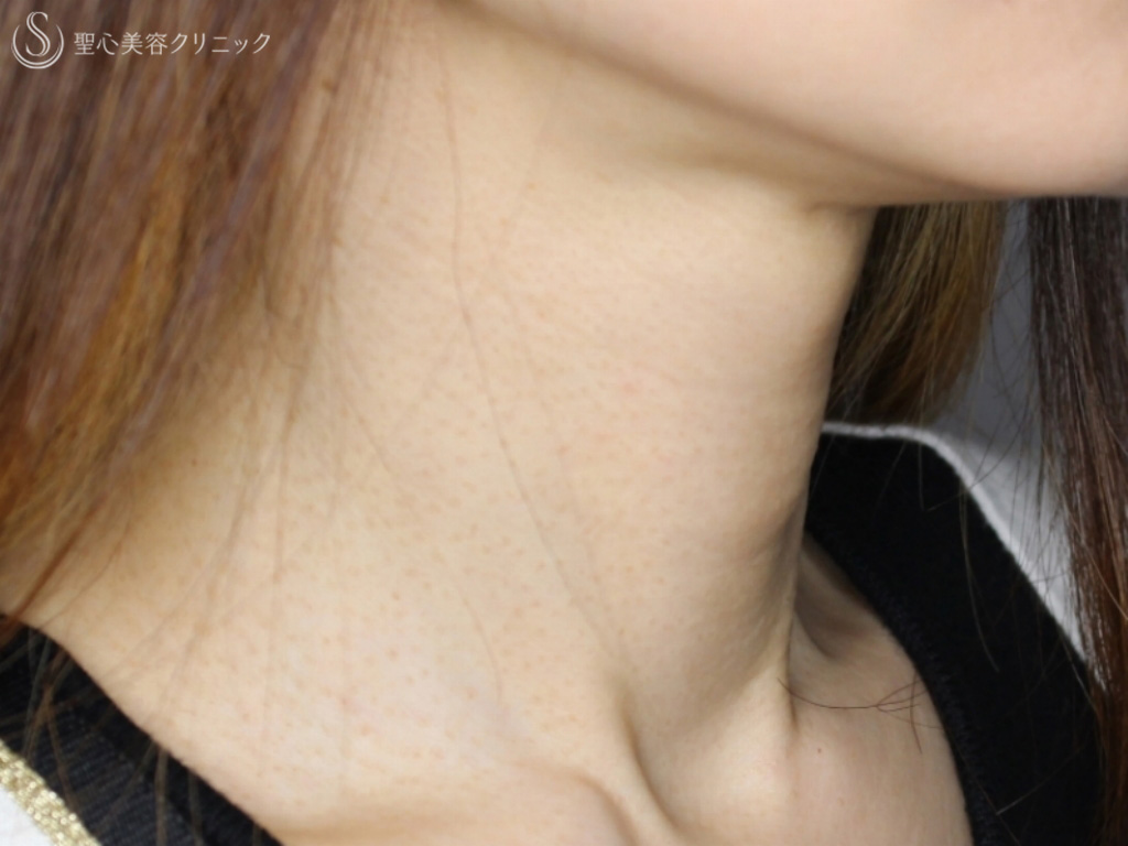 【40代女性・首の横ジワの治療】プレミアムPRP皮膚再生療法（10か月後） After 