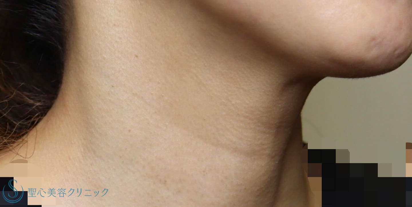 【40代女性・首の横ジワを治したい】プレミアムPRP皮膚再生療法（1年後） Before 