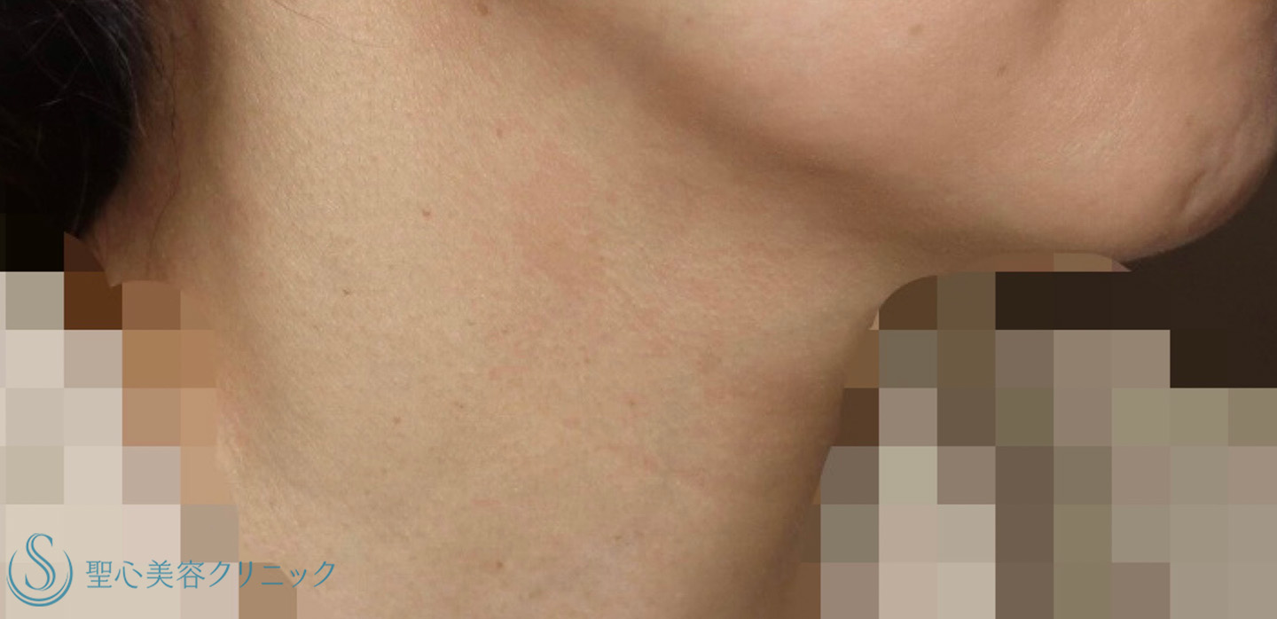 【40代女性・首の横ジワを治したい】プレミアムPRP皮膚再生療法（1年後） After 