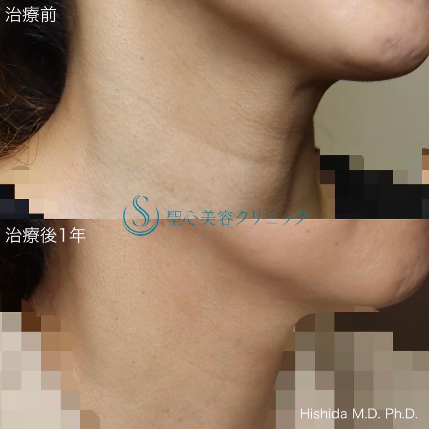 【40代女性・首の横ジワを治したい】プレミアムPRP皮膚再生療法（1年後） After 