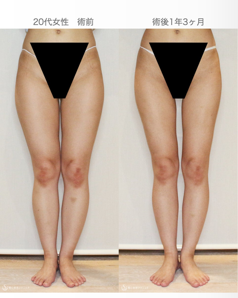 【20代女性・太もも-9cm細く美脚に】ベイザー脂肪吸引（1年3ヶ月後） After 
