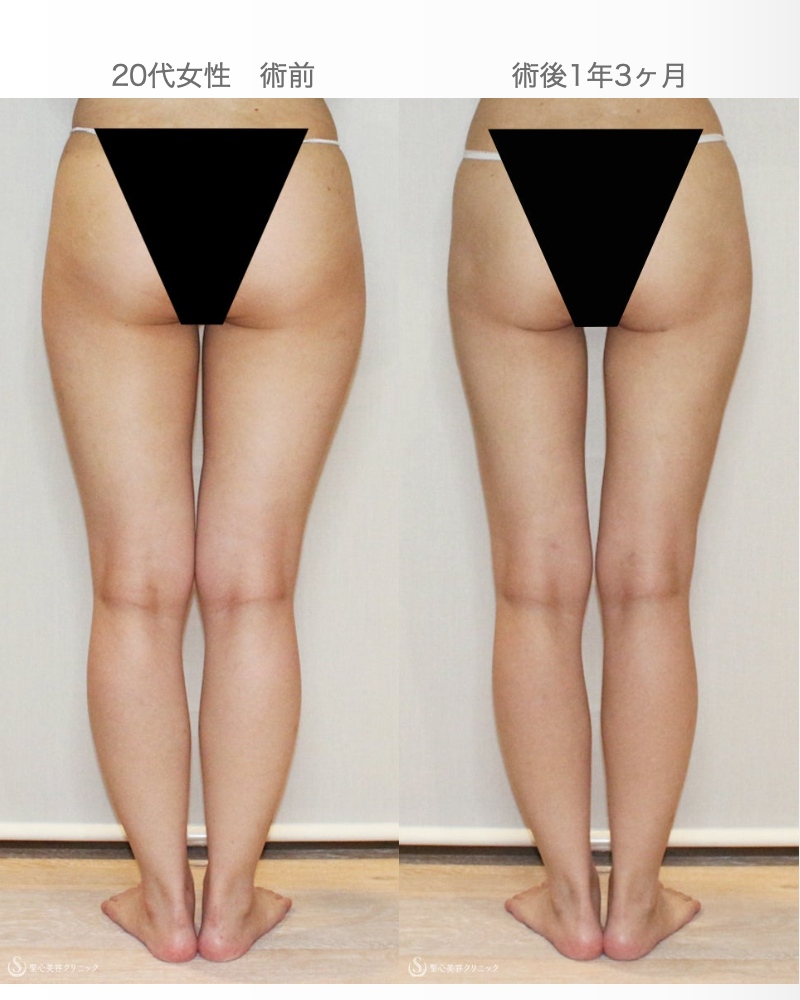 【20代女性・太もも-9cm細く美脚に】ベイザー脂肪吸引（1年3ヶ月後） After 