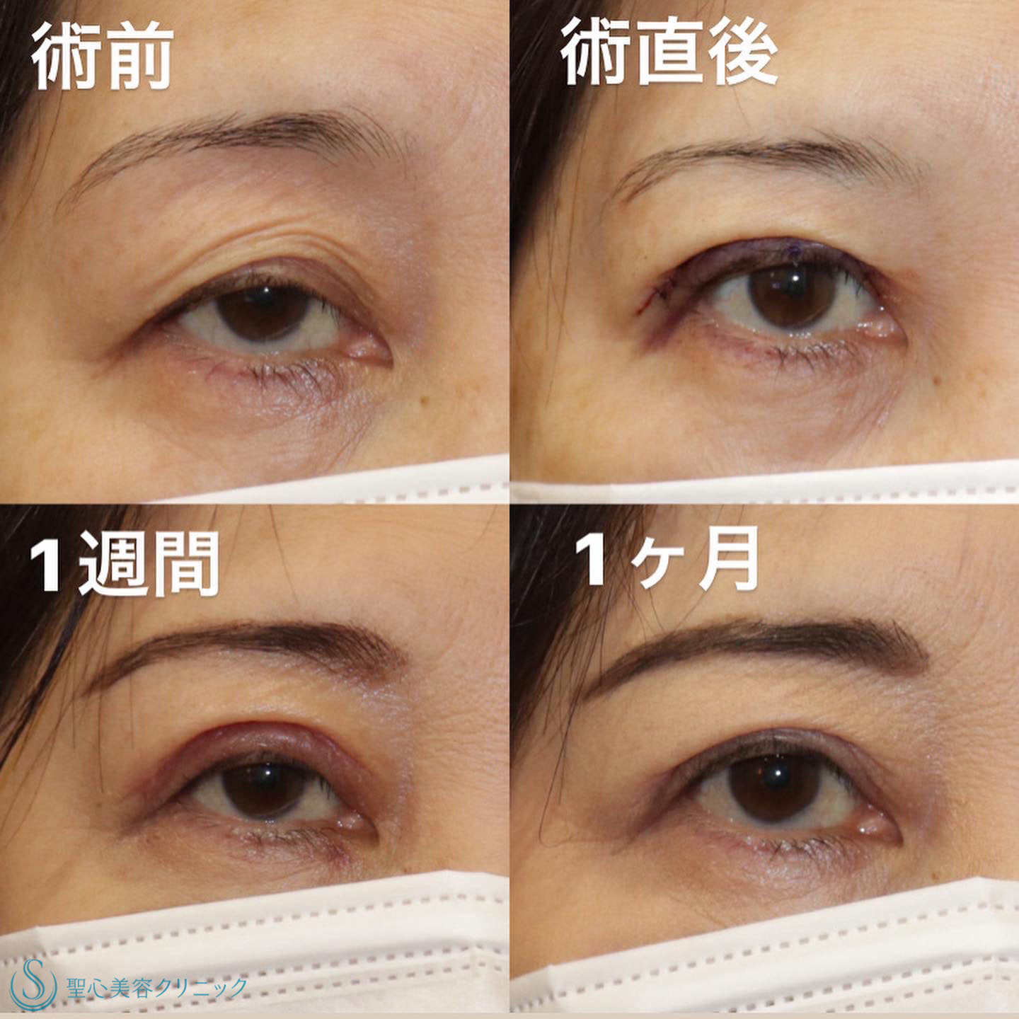 【60代女性・変わるのは見た目だけじゃない】眼瞼下垂症手術（直後/1週間後/1ヶ月後） Before 