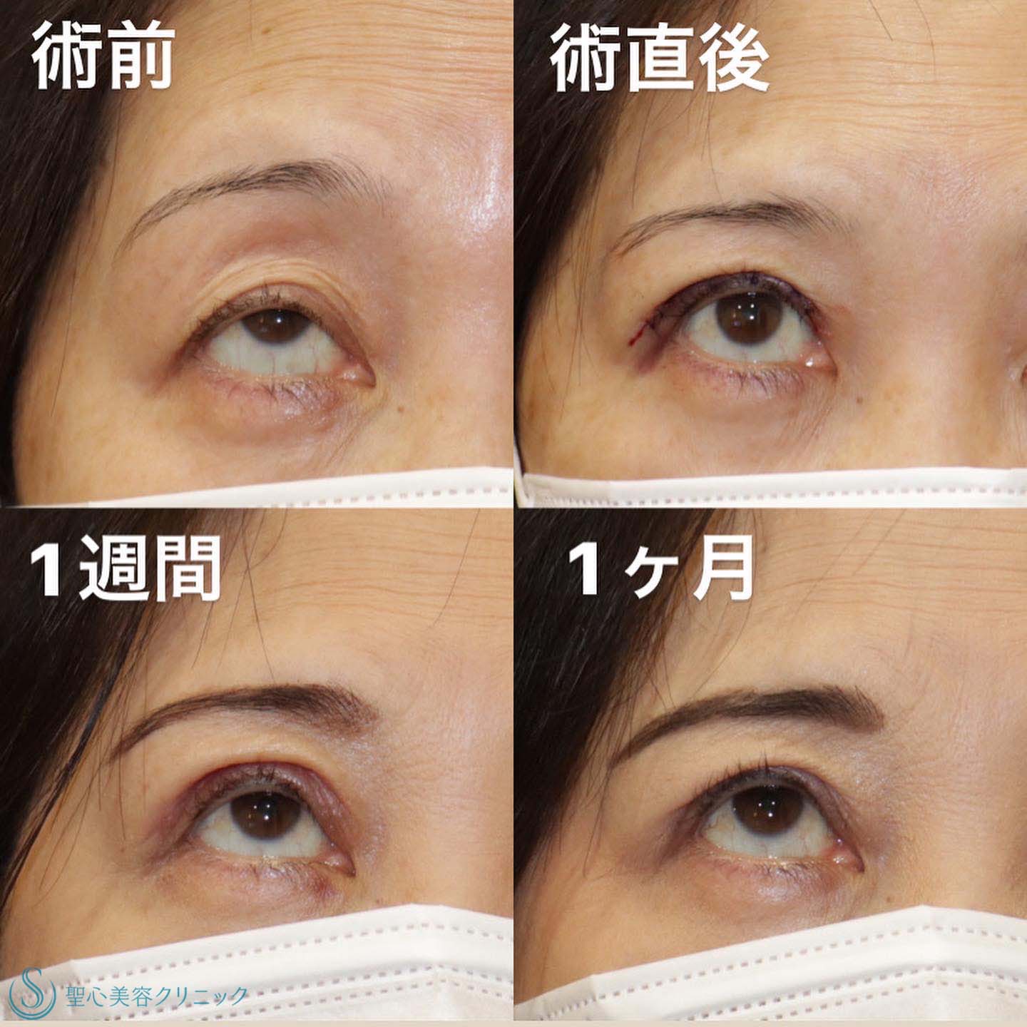 【60代女性・変わるのは見た目だけじゃない】眼瞼下垂症手術（直後/1週間後/1ヶ月後） After 