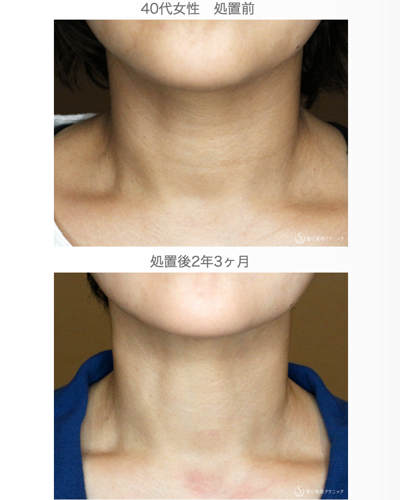 【40代女性・首の浅い横ジワを綺麗にする】プレミアムPRP皮膚再生療法（2年3ヶ月後） After 