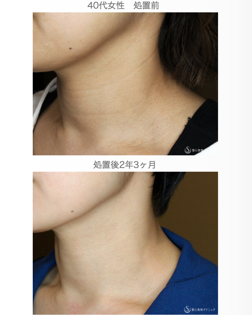 【40代女性・首の浅い横ジワを綺麗にする】プレミアムPRP皮膚再生療法（2年3ヶ月後） After 