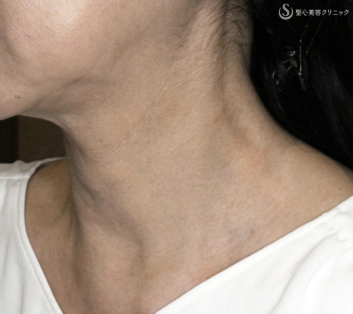 【50代女性・首の横ジワの長期経過】プレミアムPRP皮膚再生療法（10年後） After 