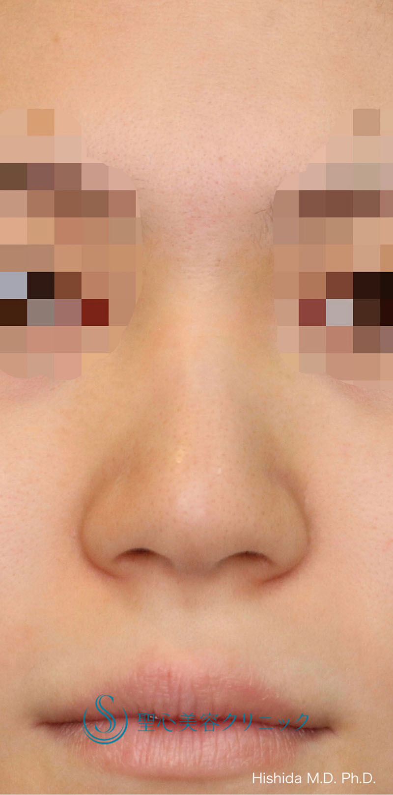 【20代女性・鼻を高く鼻先もバランスよくスッキリ！！】プロテーゼ＋鼻尖縮小＋鼻尖形成（耳介軟骨移植・ストラット法）＋小鼻縮小（術後1ヶ月） Before 