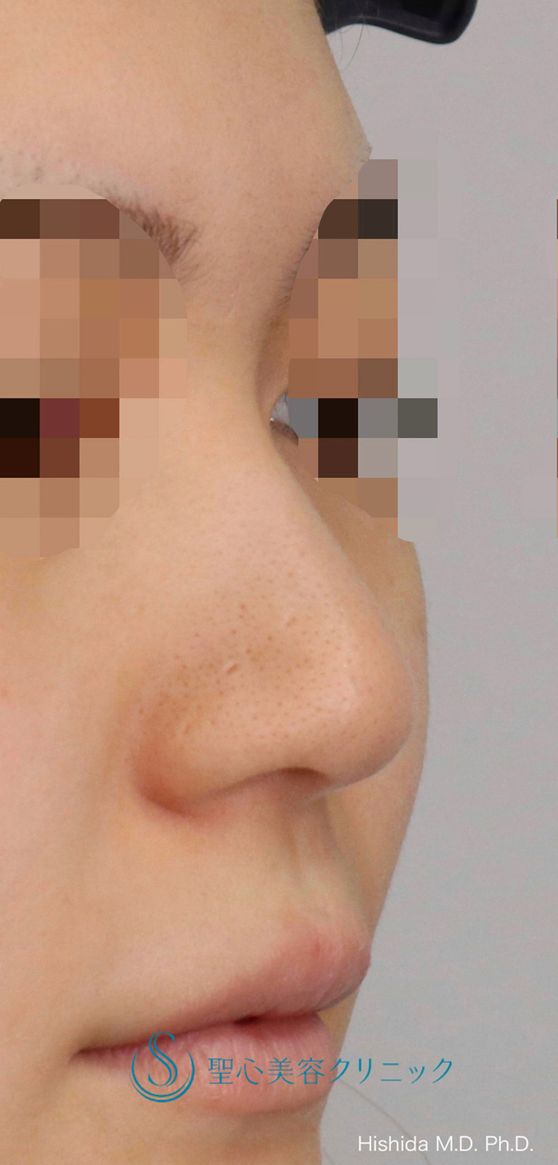 【20代女性・鼻を高く鼻先もバランスよくスッキリ！！】プロテーゼ＋鼻尖縮小＋鼻尖形成（耳介軟骨移植・ストラット法）＋小鼻縮小（術後1ヶ月） Before 