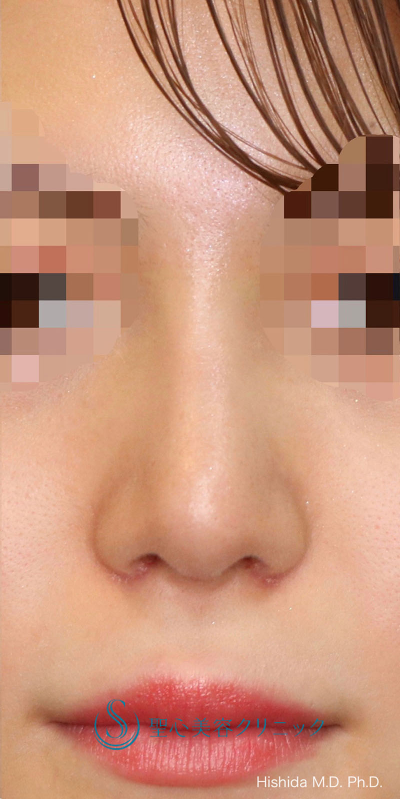 【20代女性・鼻を高く鼻先もバランスよくスッキリ！！】プロテーゼ＋鼻尖縮小＋鼻尖形成（耳介軟骨移植・ストラット法）＋小鼻縮小（術後1ヶ月） After 