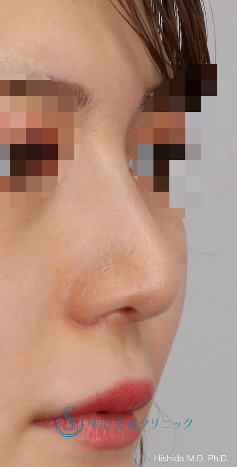 【20代女性・鼻を高く鼻先もバランスよくスッキリ！！】プロテーゼ＋鼻尖縮小＋鼻尖形成（耳介軟骨移植・ストラット法）＋小鼻縮小（術後1ヶ月） After 