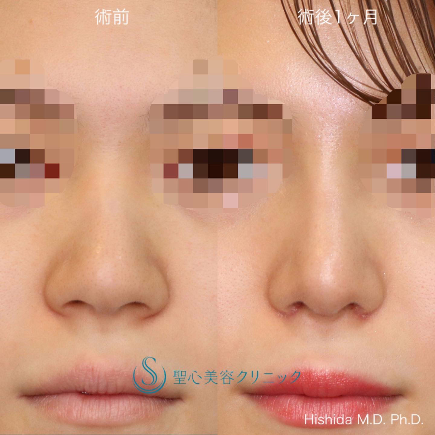 【20代女性・鼻を高く鼻先もバランスよくスッキリ！！】プロテーゼ＋鼻尖縮小＋鼻尖形成（耳介軟骨移植・ストラット法）＋小鼻縮小（術後1ヶ月） After 