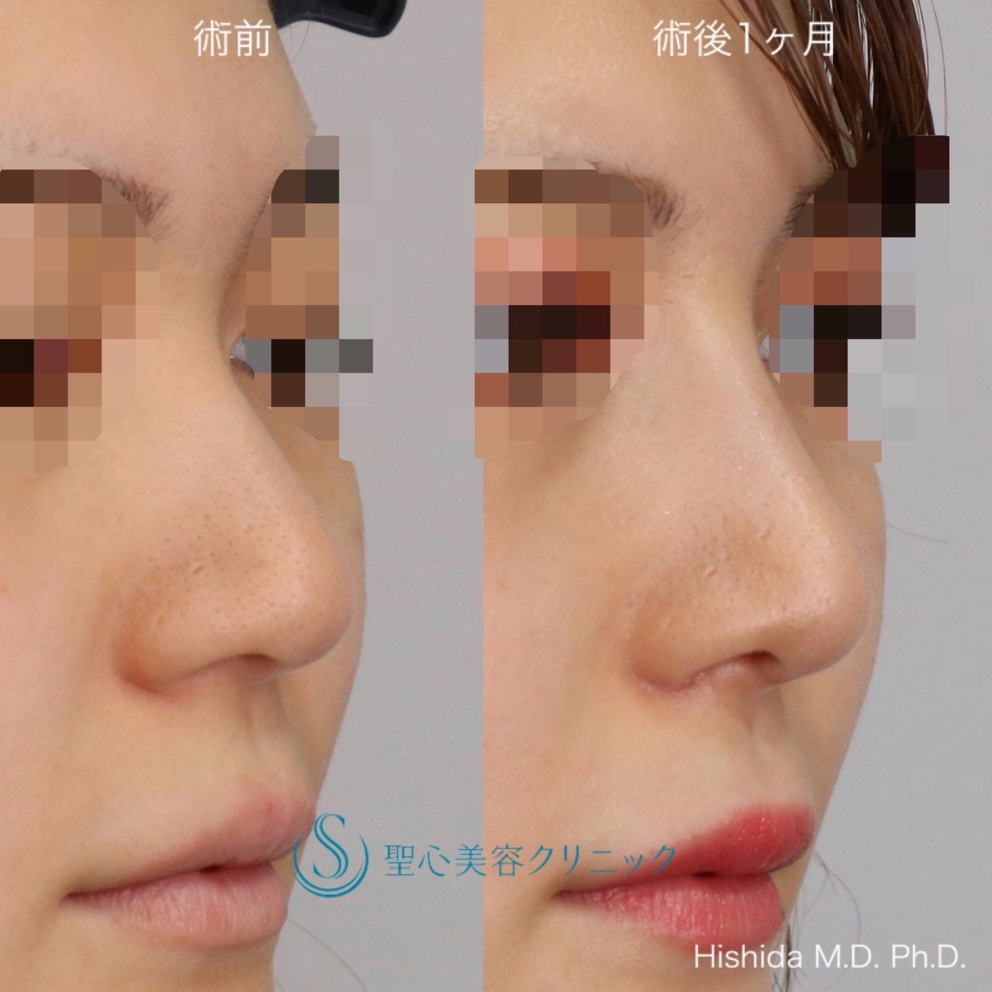 【20代女性・鼻を高く鼻先もバランスよくスッキリ！！】プロテーゼ＋鼻尖縮小＋鼻尖形成（耳介軟骨移植・ストラット法）＋小鼻縮小（術後1ヶ月） After 