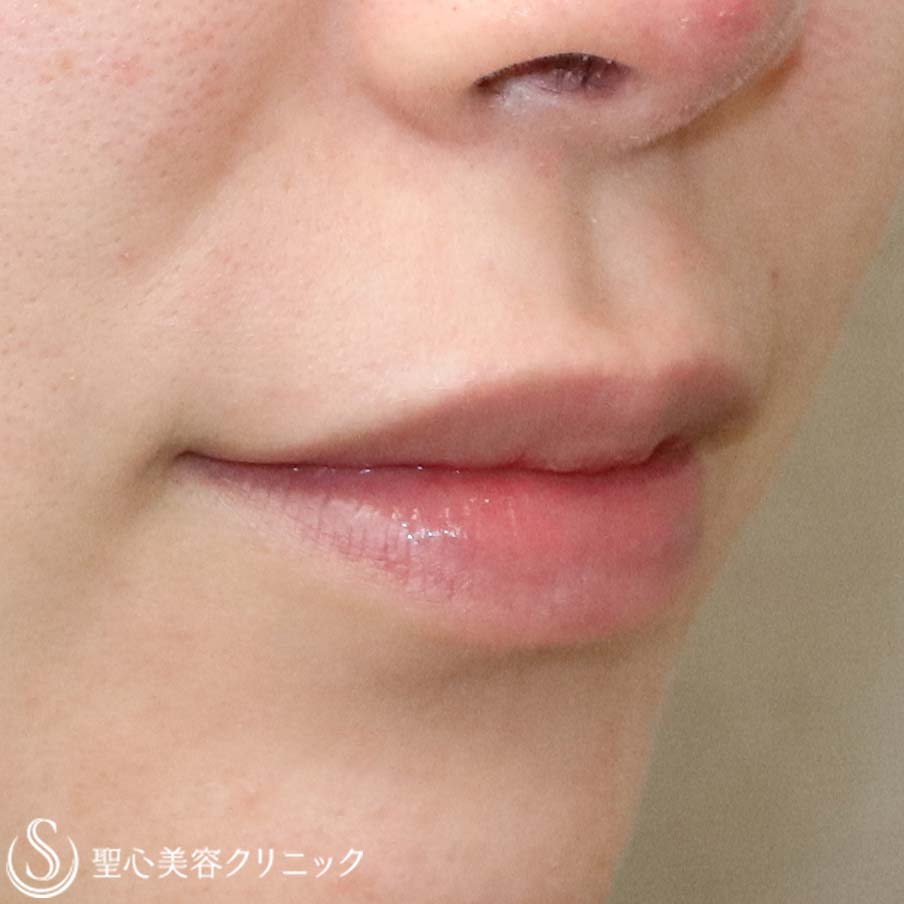 【20代女性・唇に立体感を】鼻下短縮術（人中短縮・リップリフト）（3か月後） Before 