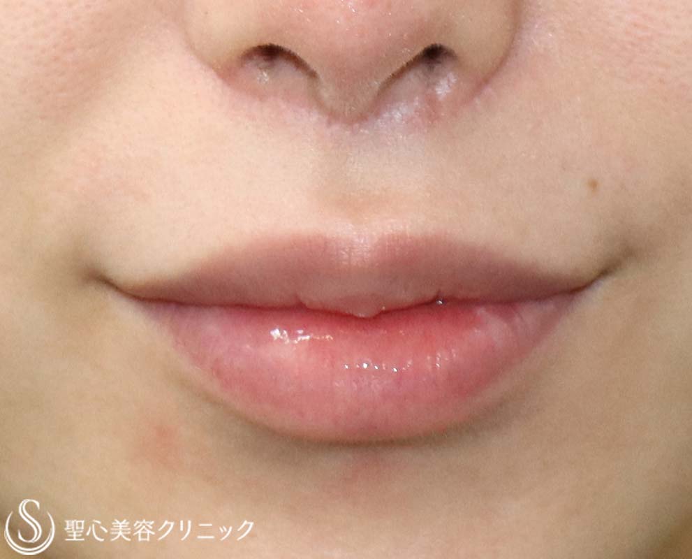 【20代女性・唇に立体感を】鼻下短縮術（人中短縮・リップリフト）（3か月後） After 