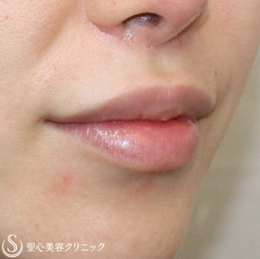 【20代女性・唇に立体感を】鼻下短縮術（人中短縮・リップリフト）（3か月後） After 