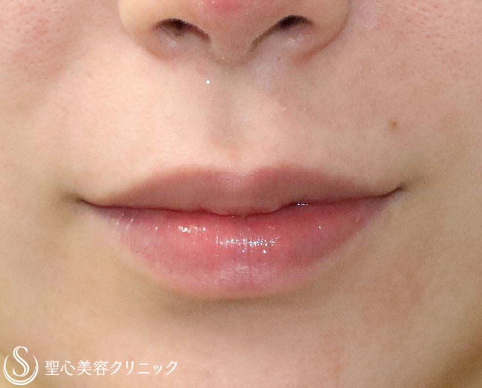 【20代女性・唇に立体感を】鼻下短縮術（人中短縮・リップリフト）（3か月後） Before 