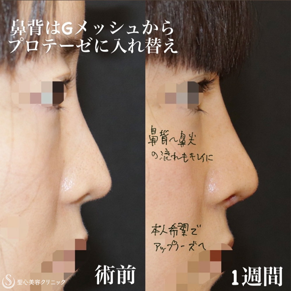 鼻形成術 鼻尖形成の手術方法や症例を名医が解説｜鼻整形と人中短縮手術の