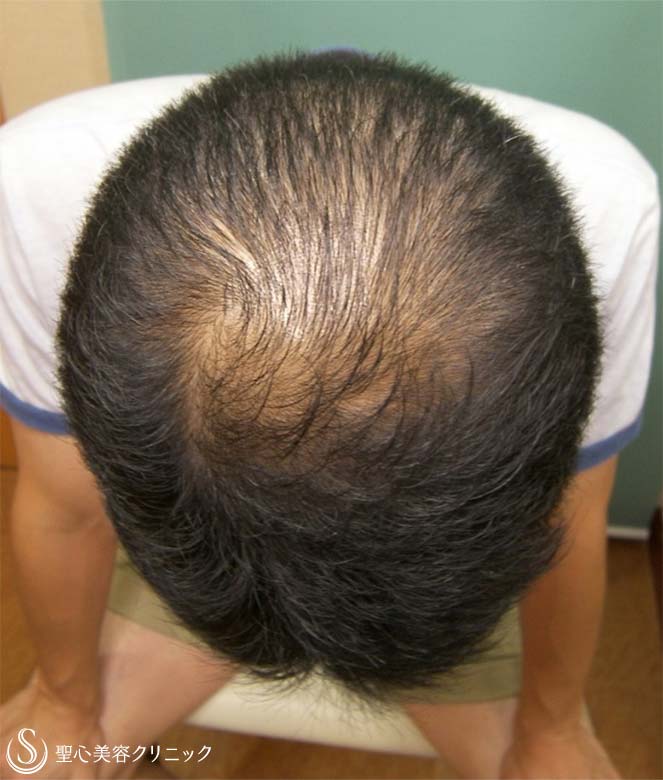 【50代男性・毛髪】プロペシア、アボルブ、デュタステリド（12年後） Before 