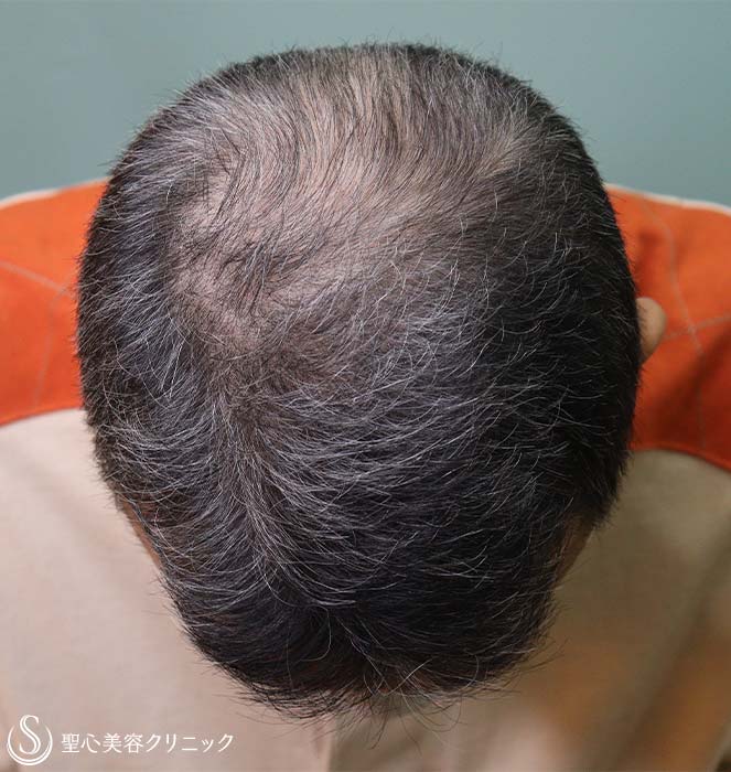 【50代男性・毛髪】プロペシア、アボルブ、デュタステリド（12年後） After 