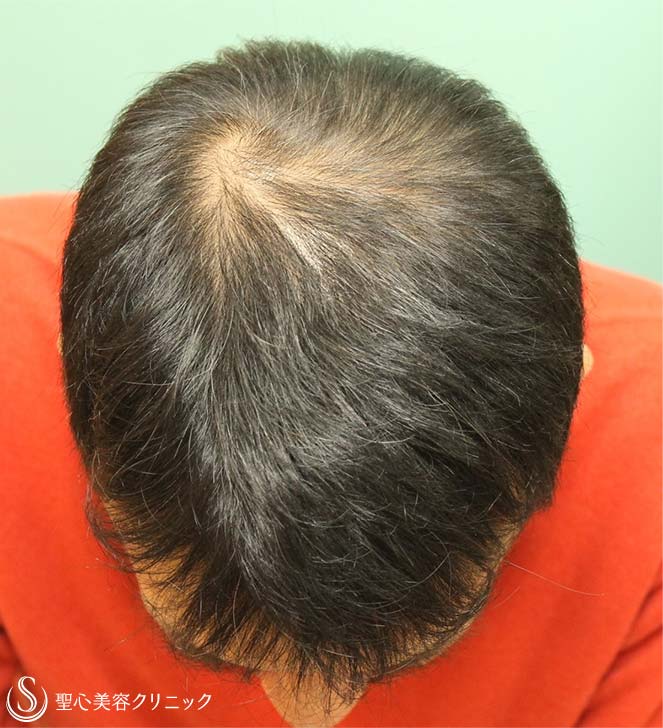 【50代男性・毛髪】プロペシア、アボルブ、デュタステリド（12年後） After 
