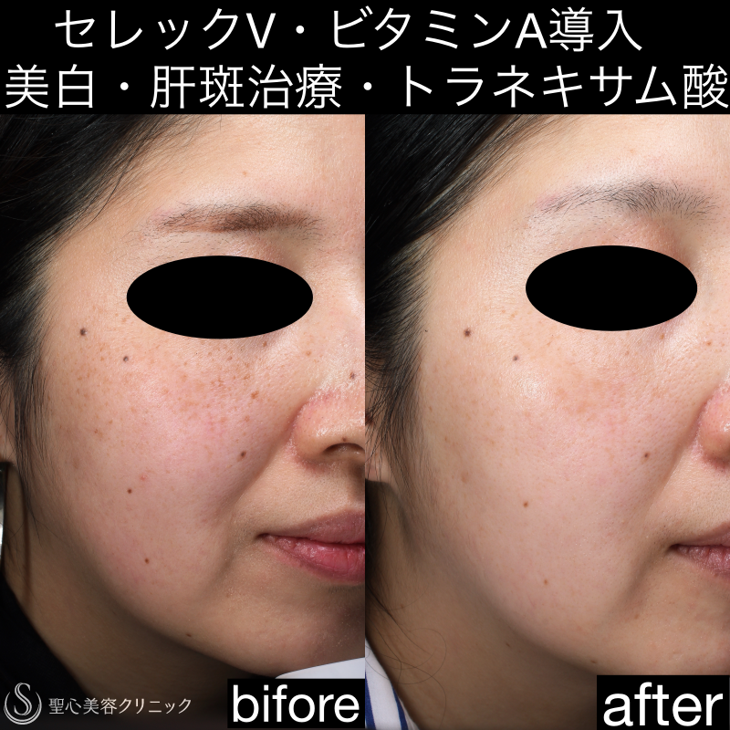 【40代女性・美肌治療】セレックV＋トラネキサム酸錠 Before 