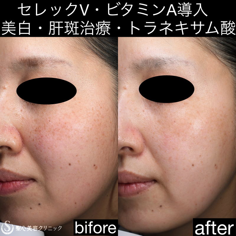 【40代女性・美肌治療】セレックV＋トラネキサム酸錠 After 