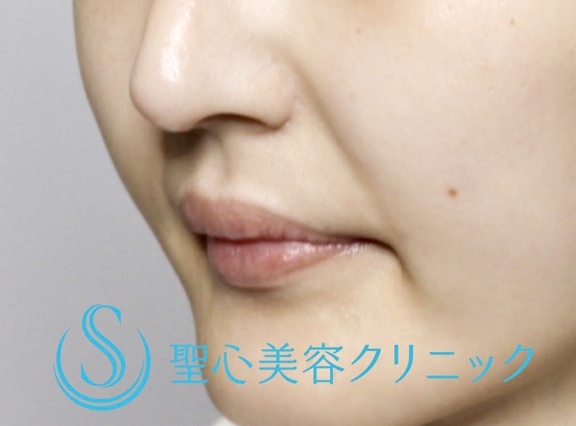 【20代女性・ふっくらとした唇に】スマイルリップ（ヒアルロン酸注入直後） Before 