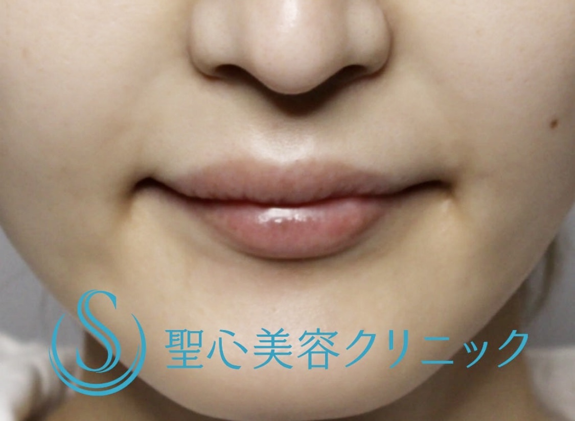 【20代女性・ふっくらとした唇に】スマイルリップ（ヒアルロン酸注入直後） Before 