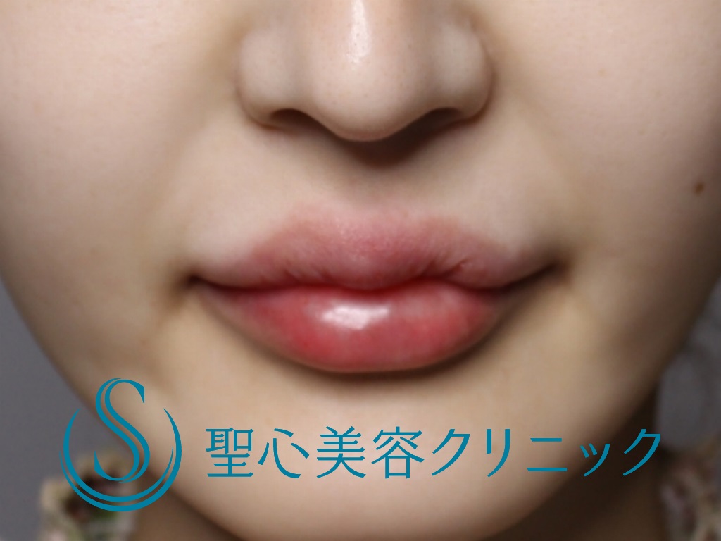 【20代女性・ふっくらとした唇に】スマイルリップ（ヒアルロン酸注入直後） After 