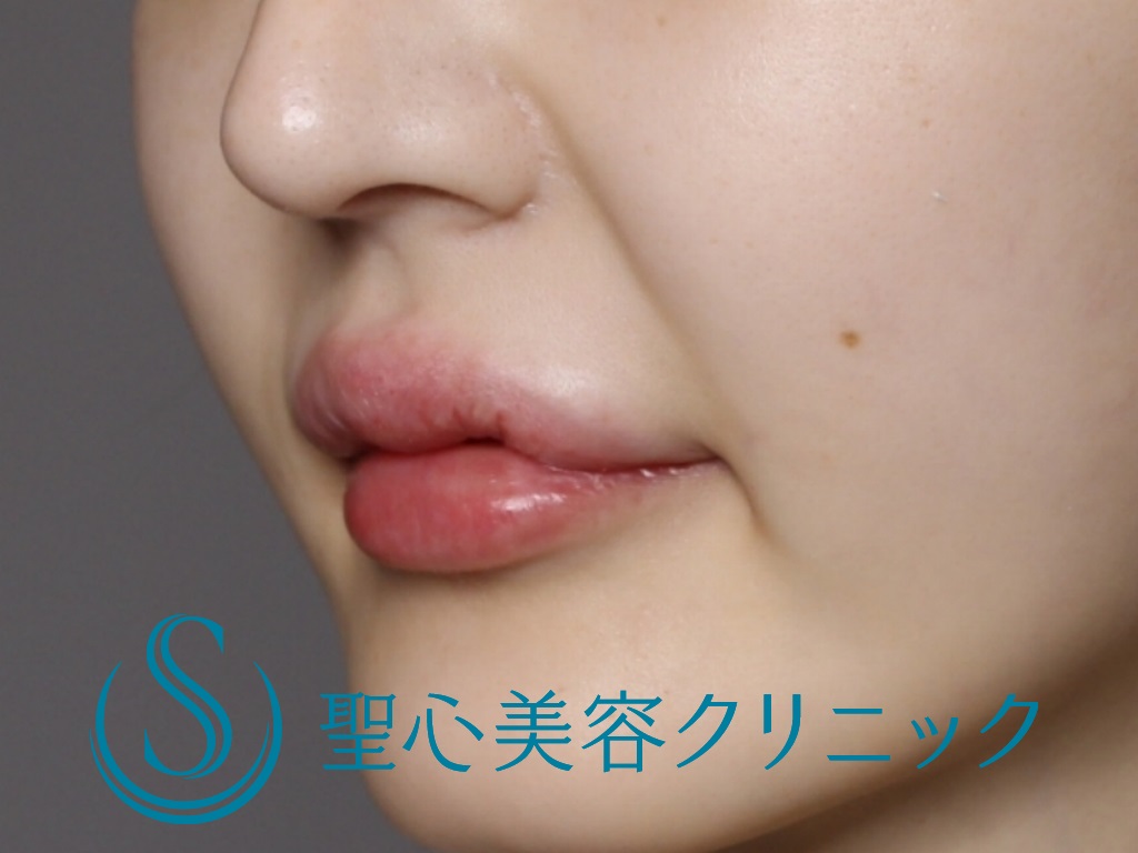 【20代女性・ふっくらとした唇に】スマイルリップ（ヒアルロン酸注入直後） After 