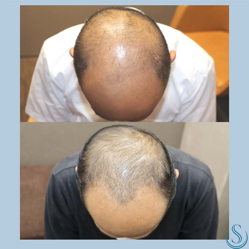 【50代男性・前頭部〜頭頂部にかけての薄毛】RichExosome（リッシェゾーム）（6回コース5回目終了後） Before 