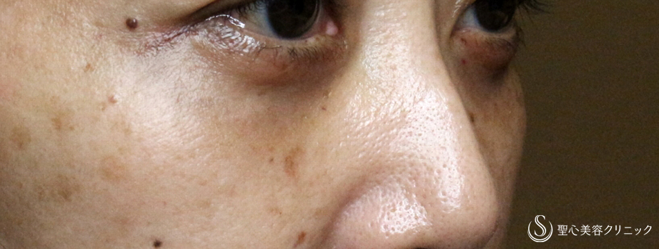 【40代女性・目の下だけで若返る】表ハムラ+α法「Ver.2」単独（3年後） After 