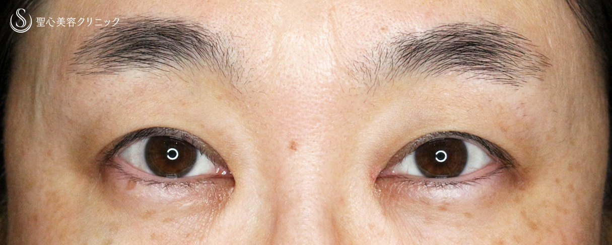 【40代女性・コンタクトレンズ下垂の第一選択】切らない眼瞼下垂+α法（4年後） After 