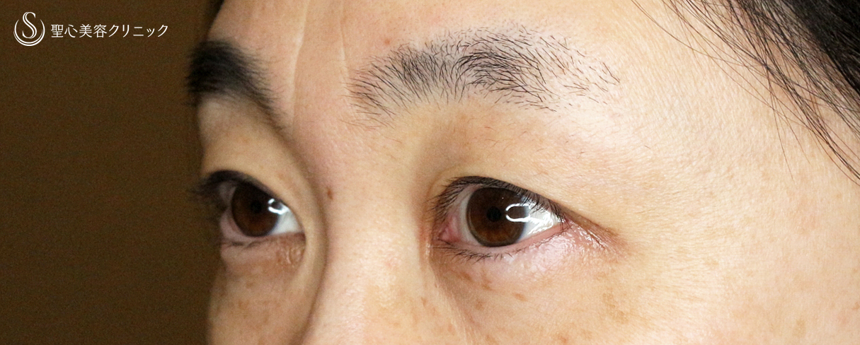 【40代女性・コンタクトレンズ下垂の第一選択】切らない眼瞼下垂+α法（4年後） After 