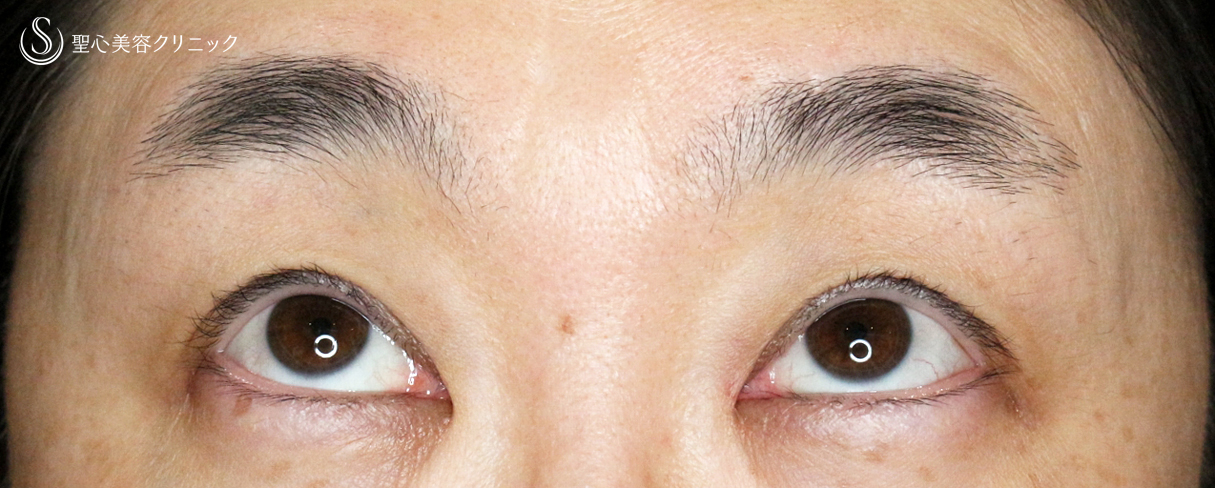 【40代女性・コンタクトレンズ下垂の第一選択】切らない眼瞼下垂+α法（4年後） After 