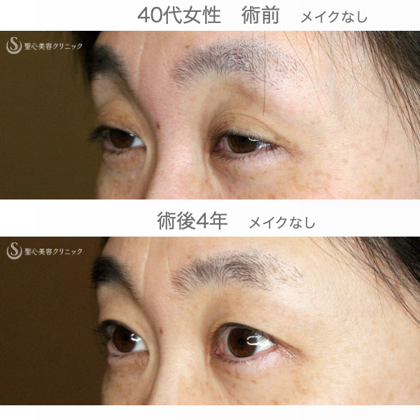 【40代女性・コンタクトレンズ下垂の第一選択】切らない眼瞼下垂+α法（4年後） After 