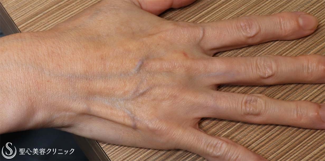 【50代女性・手の甲の若返り】プレミアムPRP皮膚再生療法（2ヶ月後） Before 