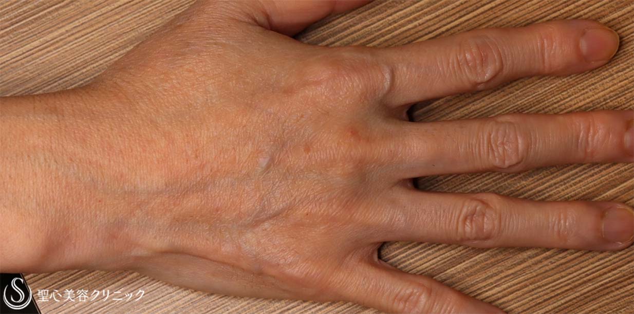 【50代女性・手の甲の若返り】プレミアムPRP皮膚再生療法（2ヶ月後） After 