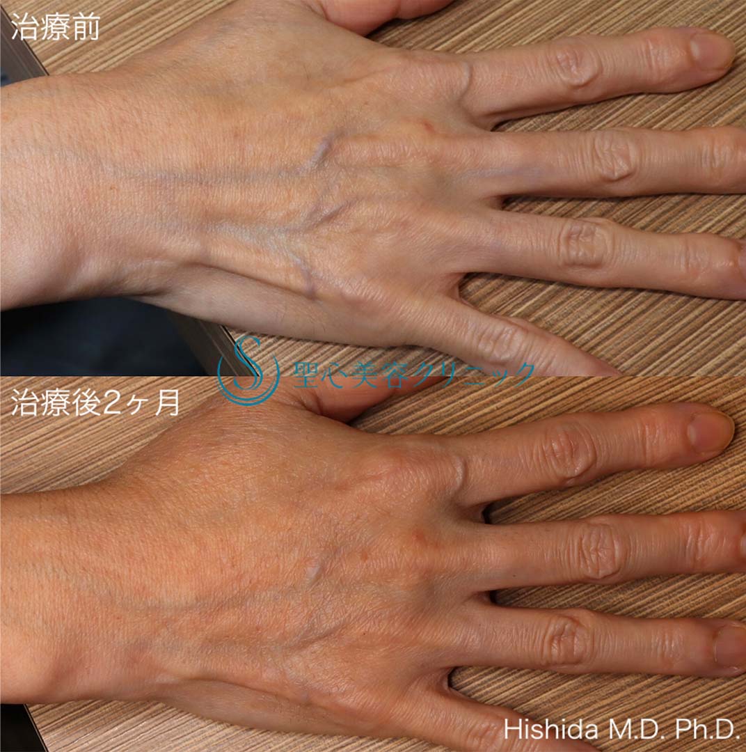 【50代女性・手の甲の若返り】プレミアムPRP皮膚再生療法（2ヶ月後） After 