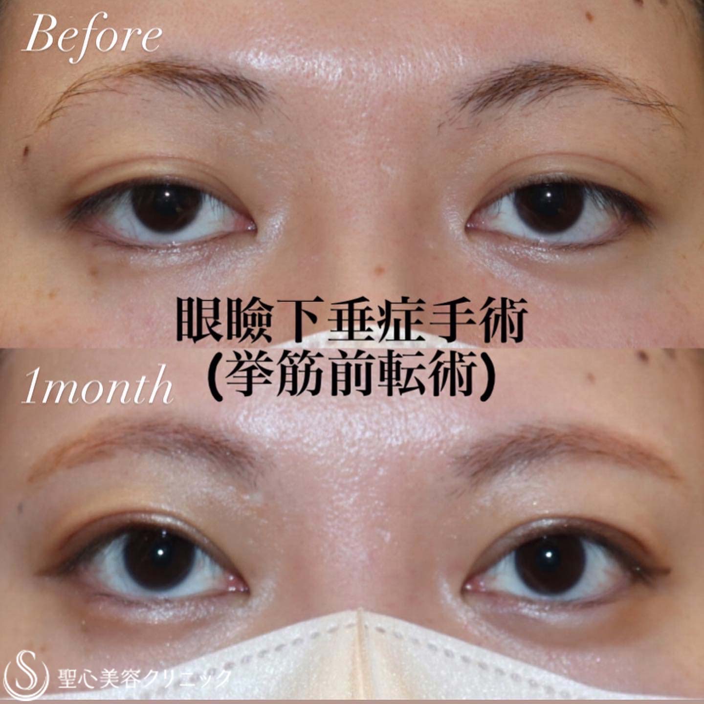 【20代女性・目は開きます】眼瞼下垂症手術（1ヶ月後） Before 