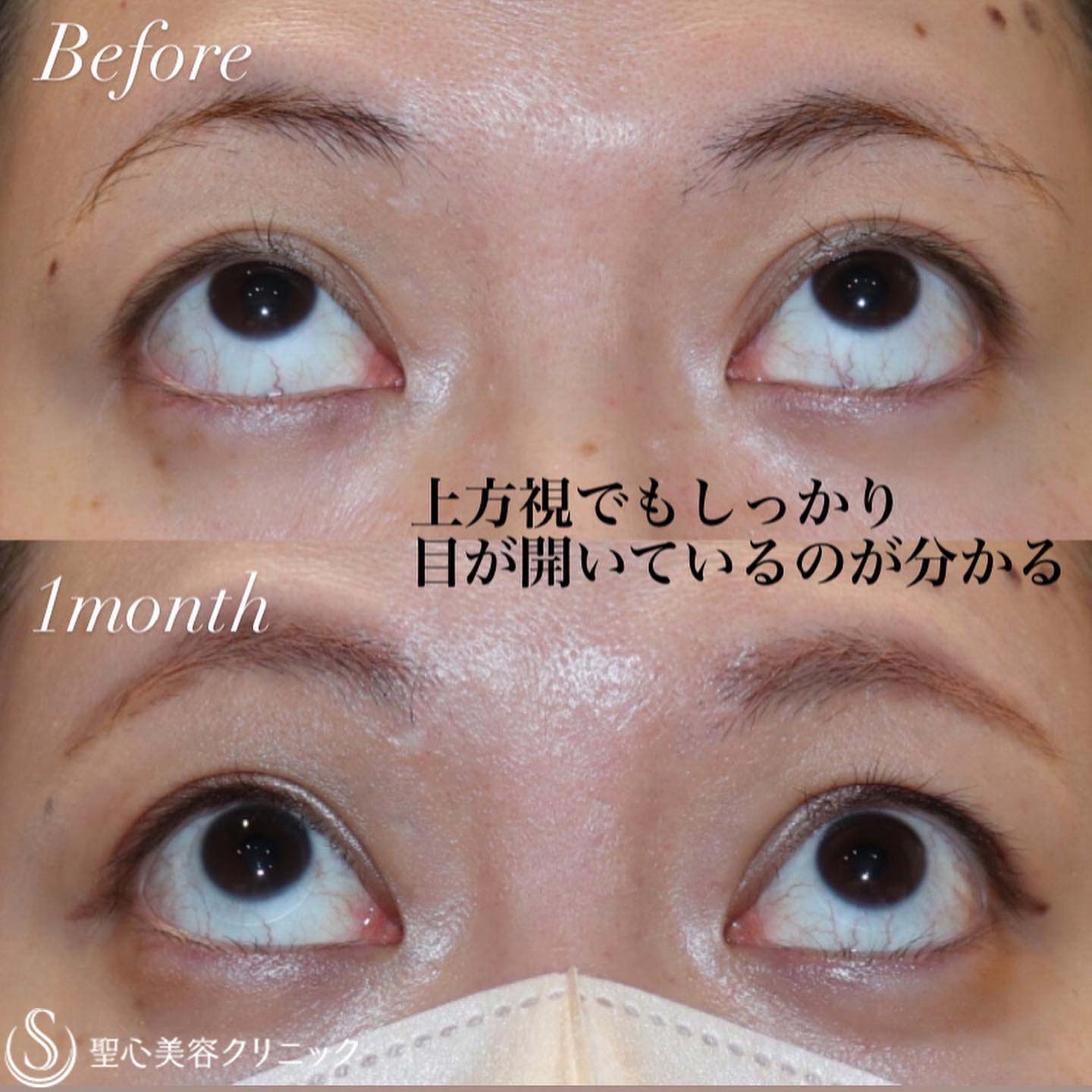 【20代女性・目は開きます】眼瞼下垂症手術（1ヶ月後） After 