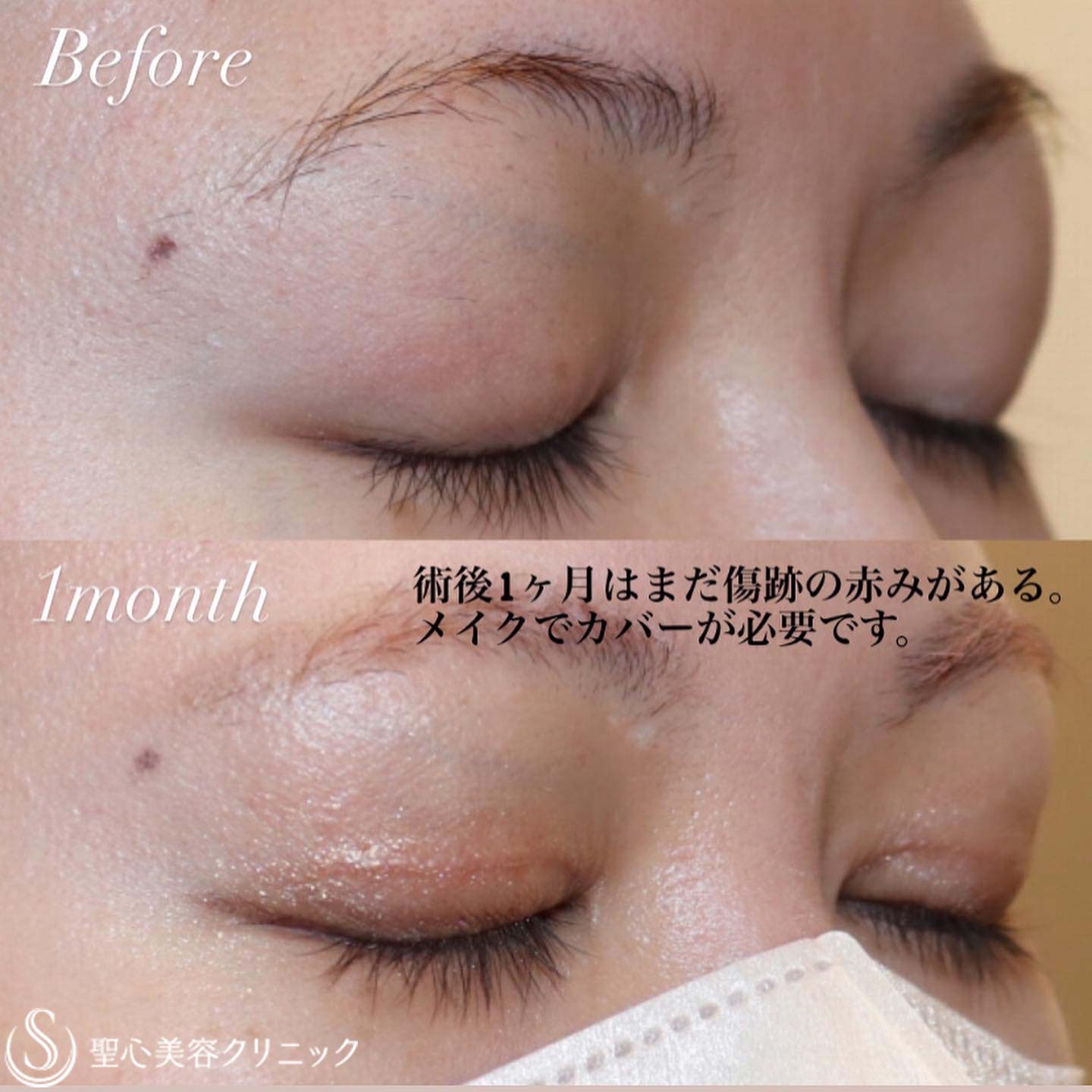 【20代女性・目は開きます】眼瞼下垂症手術（1ヶ月後） Before 