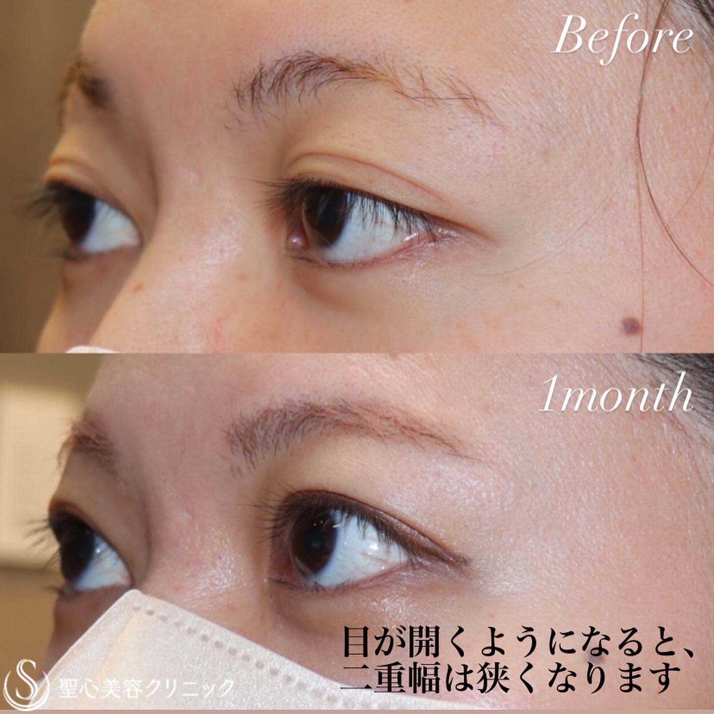 【20代女性・目は開きます】眼瞼下垂症手術（1ヶ月後） After 