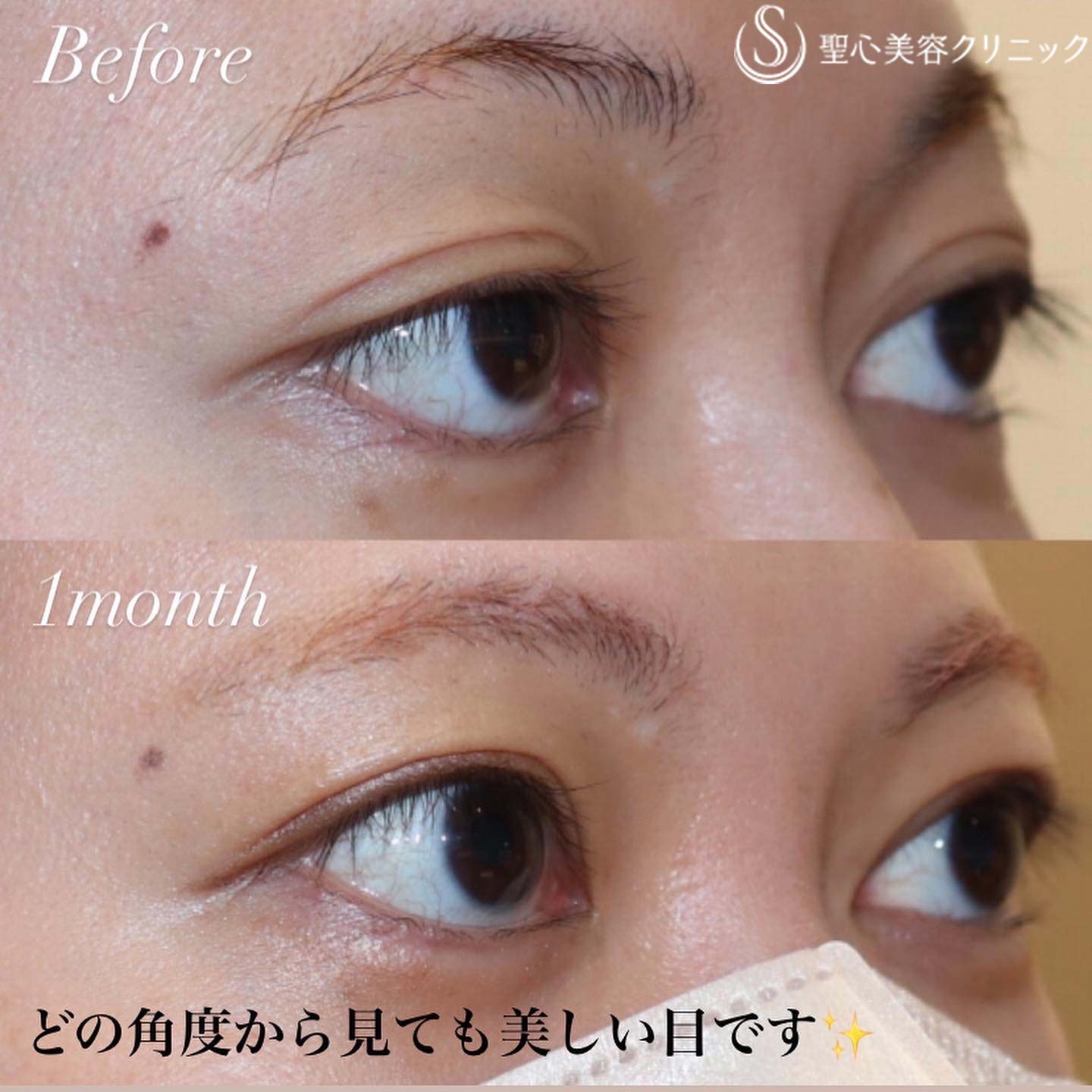 【20代女性・目は開きます】眼瞼下垂症手術（1ヶ月後） After 