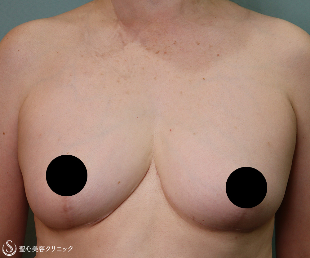 【50代女性・乳房のサイズ】乳房縮小術（1ヶ月後/1年10か月後） After 