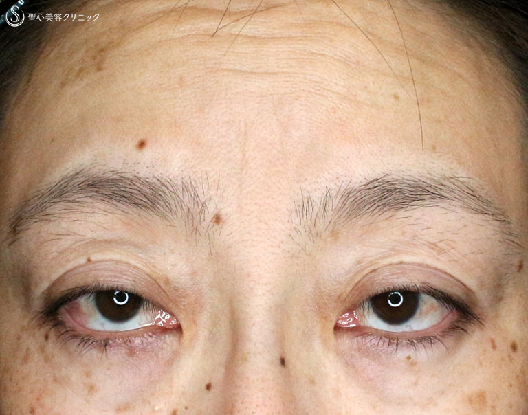 【40代女性・コンタタクトレンズ眼瞼下垂】切らない眼瞼下垂+α法（6年6ヶ月後） Before 