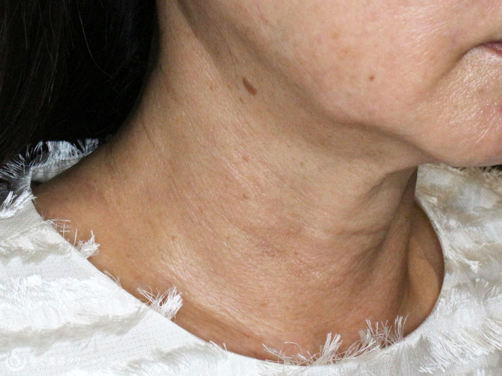 【60代女性・加齢タルミによる首の横じわ】プレミアムPRP皮膚再生療法（9ヶ月後） After 