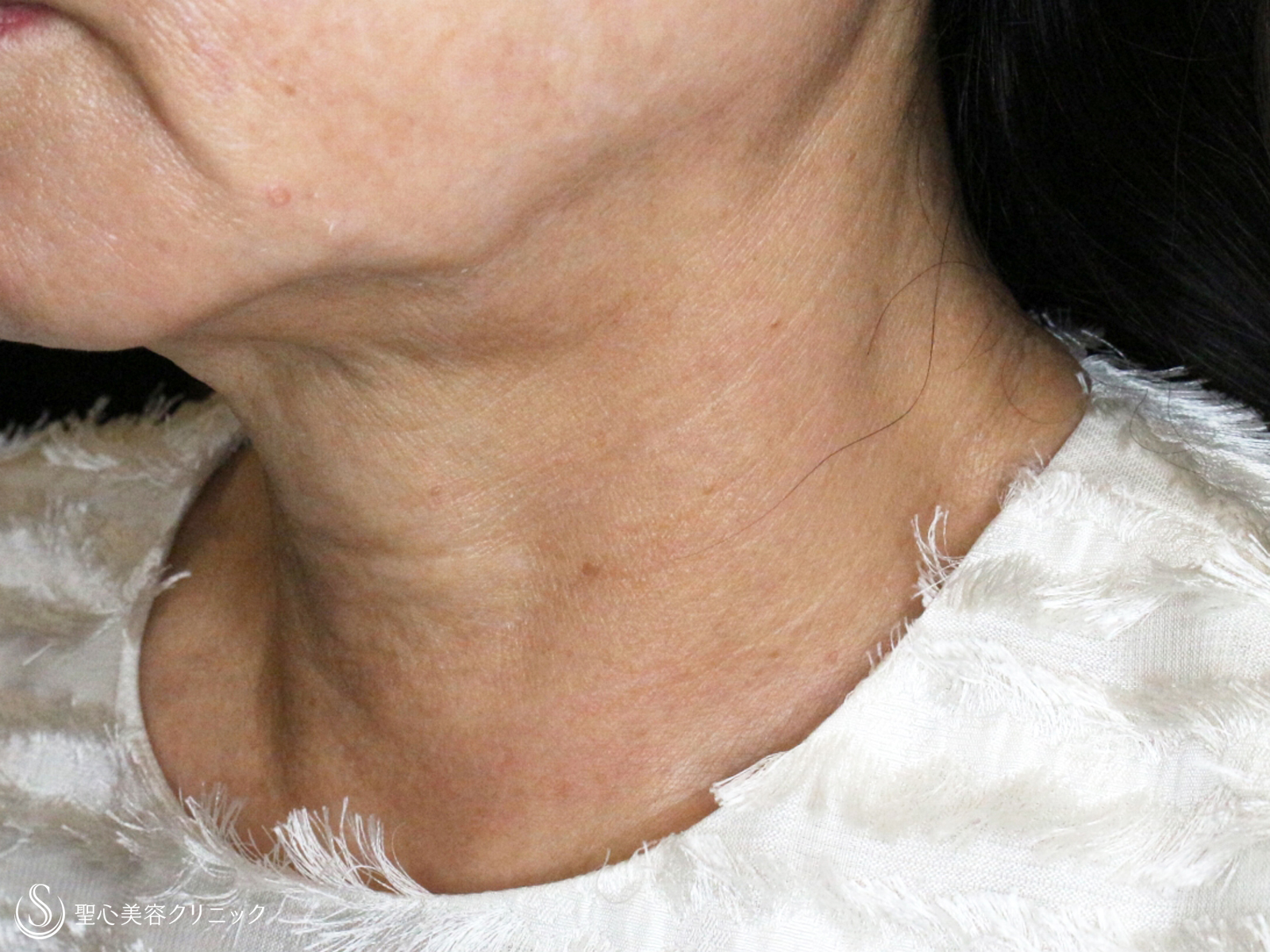 【60代女性・加齢タルミによる首の横じわ】プレミアムPRP皮膚再生療法（9ヶ月後） After 
