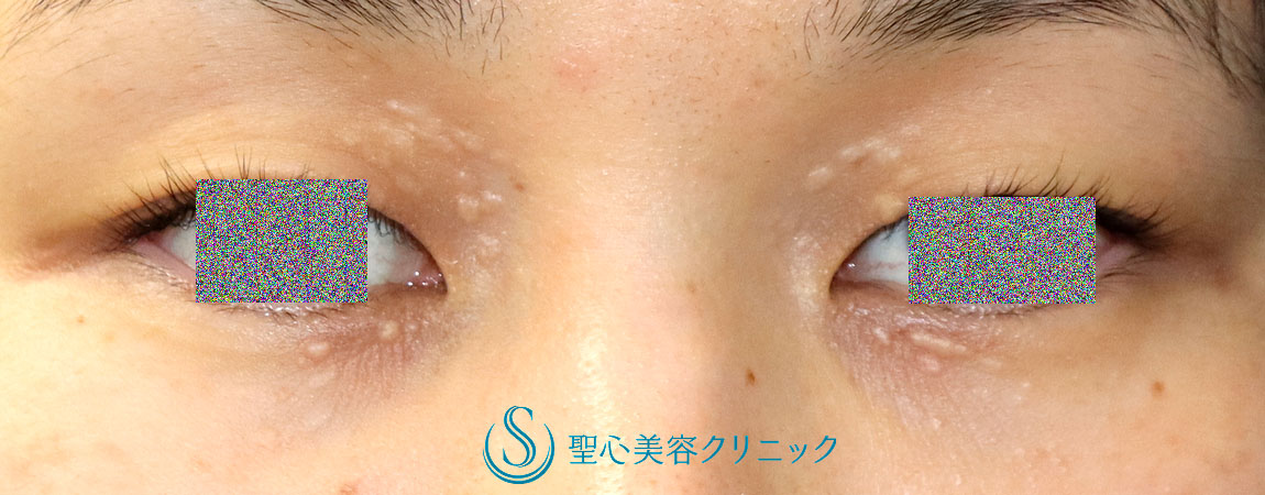 【30代女性・目の周りの汗管腫を治療したい】汗管腫・アグネス治療（聖心美容クリニック 大阪院・横浜院・大宮院 限定処置）（2回処置3か月後） Before 